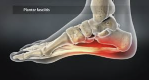plantar fasciitis, what not to do with plantar fasciitis